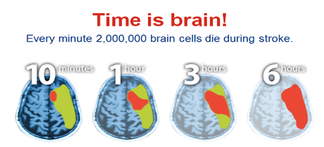 Time is Brain - Every minute 2,000,000 brain cells die during stroke